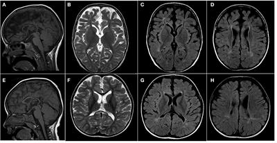 Case report: PLPHP deficiency, a rare but important cause of B6-responsive disorders: A report of three novel individuals and review of 51 cases